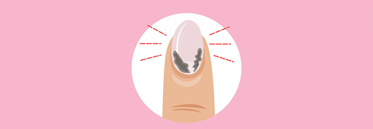 Hur uppstår allergier av nagelprodukter?